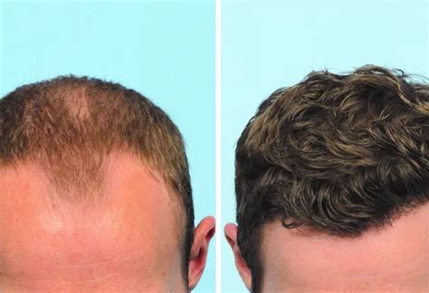 Hair Replacement for Men: 4 Ways to Restore Your Confidence