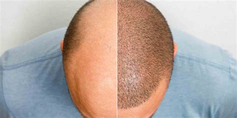 Hair Replacement for Men: The Ultimate Solution to Hair Loss