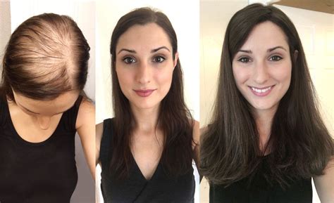 Hair Replacement for Women: 4 Must-Know Solutions for Regaining Confidence