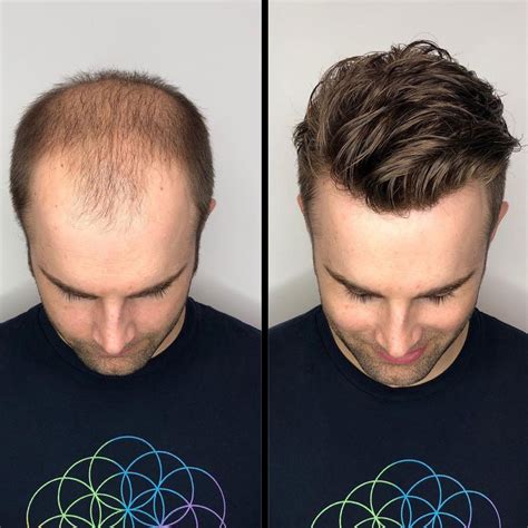 Hair System for Men: The Perfect Solution for Hair Loss