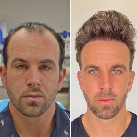 Hair Transplants: