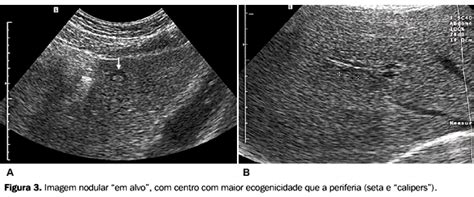 Hamartomas Biliares: Uma Visão Abrangente