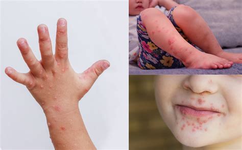 Hand Foot Mouth Disease on Face: A Comprehensive Guide for 2025