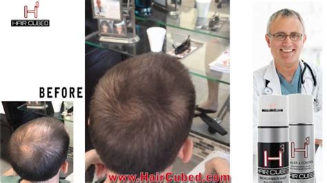 Hat of Hair: A Revolutionary Solution for Hair Loss