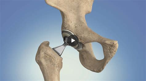 Heal Your Hips How to Prevent Hip Surgery and What to Do If You Need It Reader