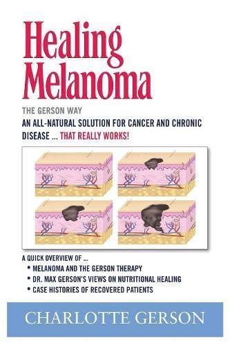 Healing Melanoma The Gerson Way Kindle Editon