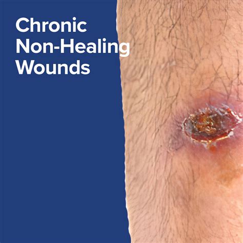 Healing Wounds Reader