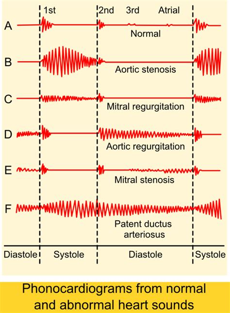 Heart Sounds Chart