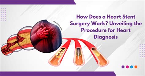 Heart Stent Recovery Time in Hospital: A Comprehensive Guide for 2025