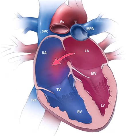 Heart defects: