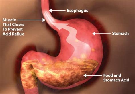 Heartburn Phlegm: Causes, Treatments, and Remedies