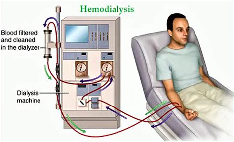 Hemodialysis