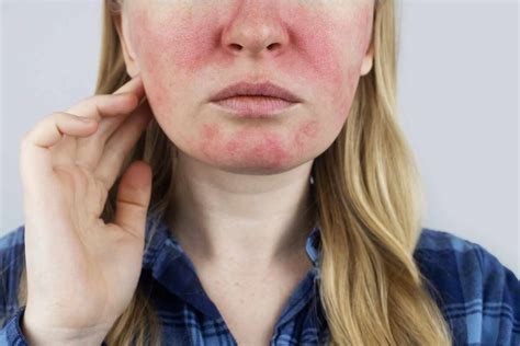 Heolalex: A Comprehensive Guide to Understanding and Treating Rosacea