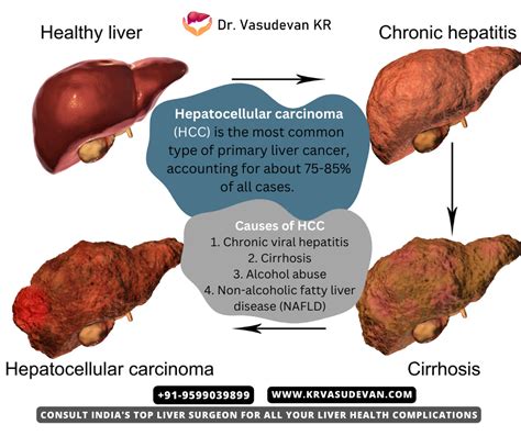 Hepatocellular carcinoma (HCC):