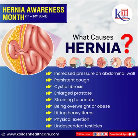 Hernia PDF