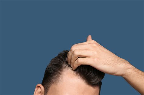 Herren-Toupets: Die perfekte Lösung für Haarausfall bei Männern