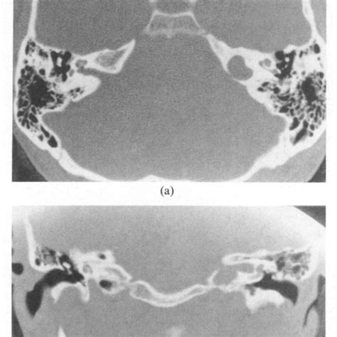 High Resolution Mr Imaging Of The Petrous Bone Using A Kindle Editon