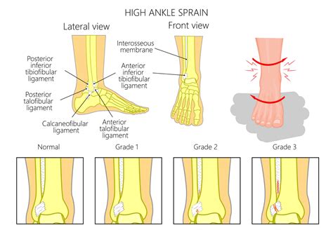 High ankle: