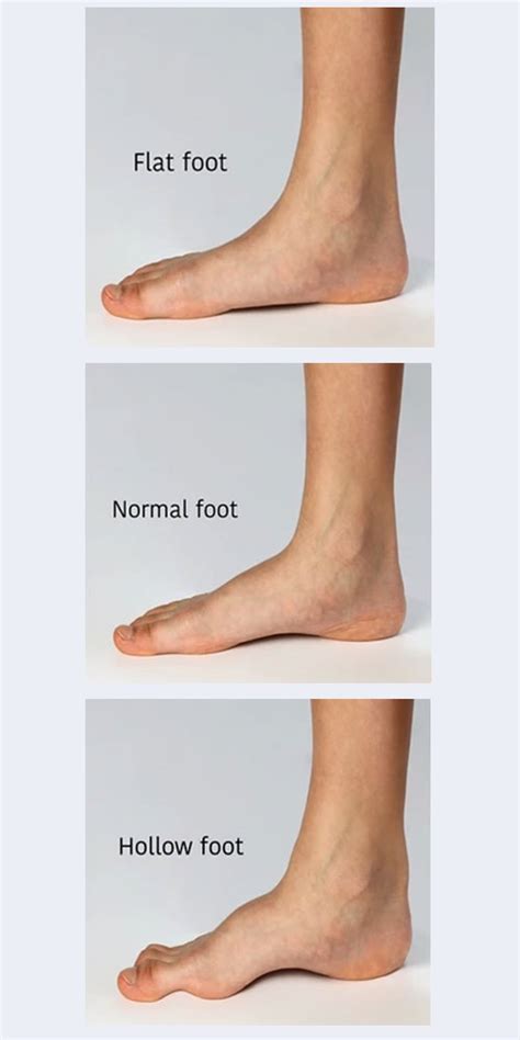 High-arched feet (pes cavus):