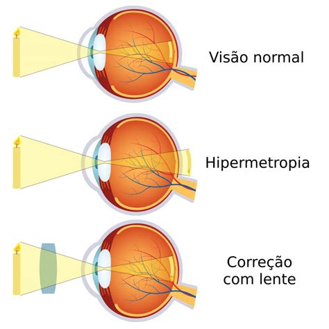 Hipermetropia