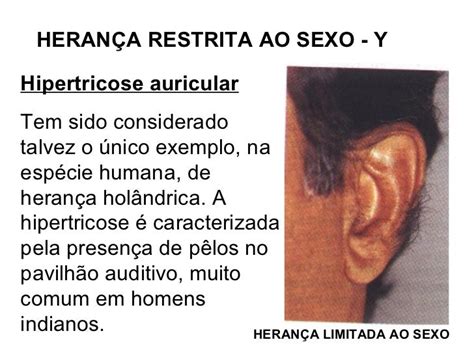 Hipertricose Auricular: Um Guia Abrangente