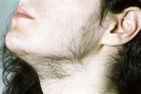 Hirsutism