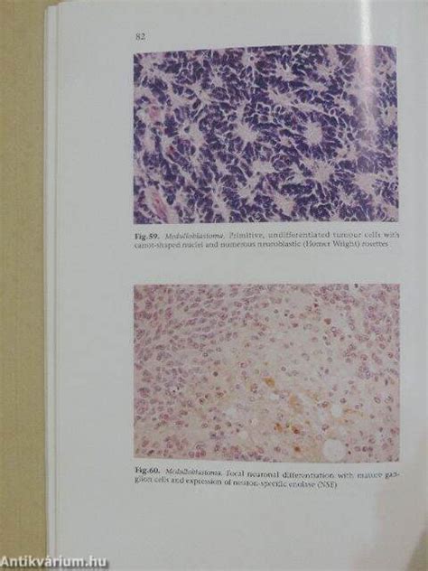 Histological Typing of Tumours of the Central Nervous System Reader
