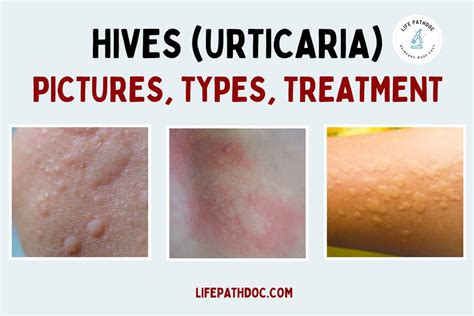 Hives That Come and Go: A Guide to Understanding Transient Urticaria