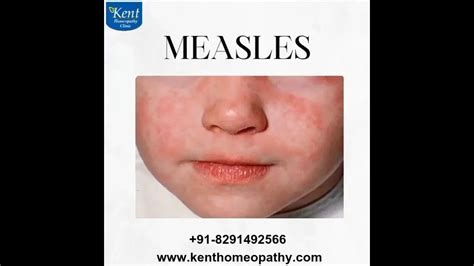 Homeopathy for Measles PDF