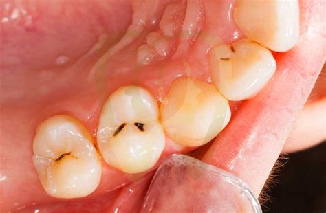 How Does Tooth Decay Look Like: A Comprehensive Guide