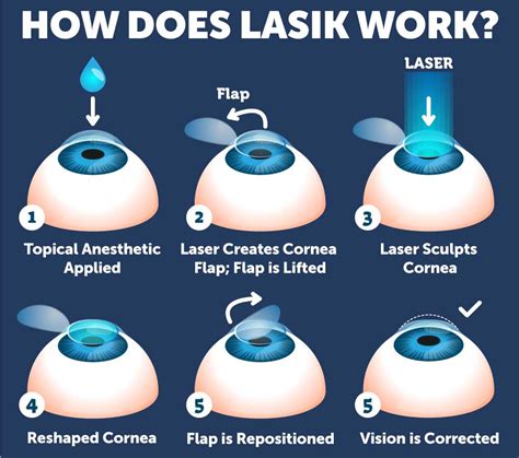 How Laser Eye Surgery Works