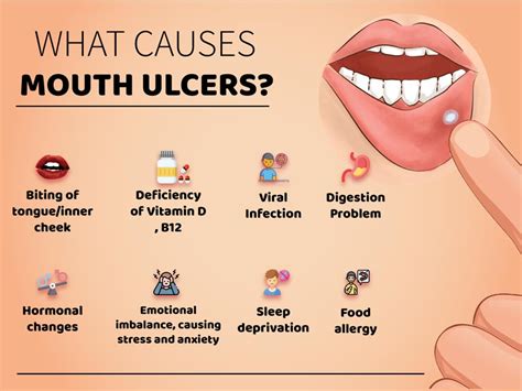 How Long Do Mouth Ulcers Take to Heal: 7-Day to 2-Week Timeline