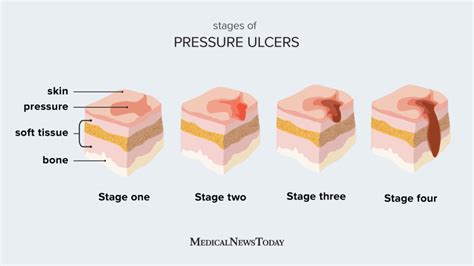 How Long Do Ulcers Take to Heal: 2025 Comprehensive Guide