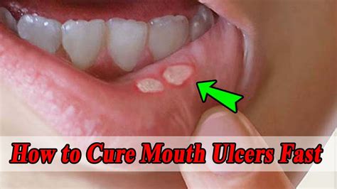 How Long Does a Mouth Ulcer Take to Heal: A Comprehensive Guide