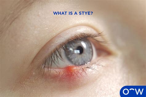 How Many Days Will A Stye Last: A Comprehensive Guide