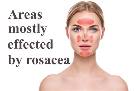 How to Beat Rosacea: 10 Powerful Strategies to Stop Facial Redness