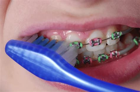 How to Choose the Right Toothbrush for Braces