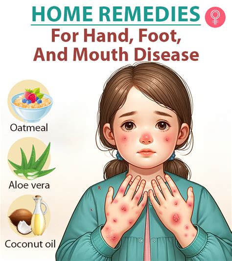 How to Cure Hand Foot Mouth Disease: 14 Steps to Relief