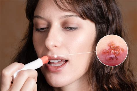 How to Cure Lip Ulcers Fast: 5 Speedy Solutions