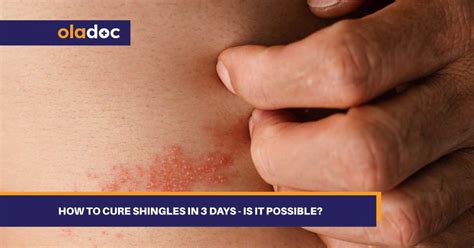 How to Cure Shingles in 3 Days: The Ultimate Guide for 2025