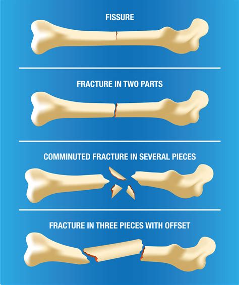 How to Find Fractures