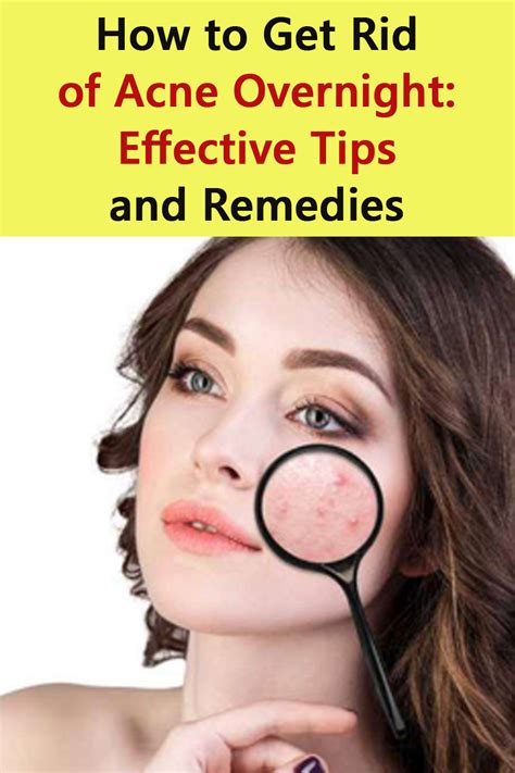 How to Get Rid of Acne: 15 Effective Tips