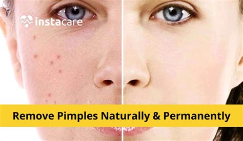 How to Get Rid of Acne Naturally: 10,000+ Tips