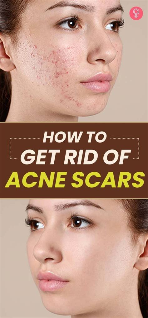 How to Get Rid of Acne Scars: A Comprehensive Guide to 9 Proven Strategies