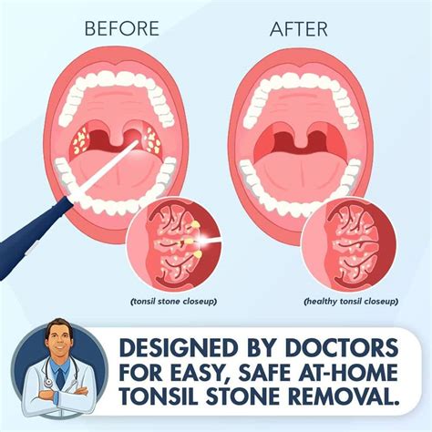 How to Get Rid of Calcium Stones in Mouth: 10 Proven Methods