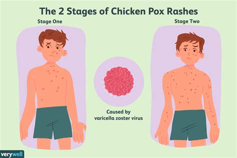 How to Get Rid of Chickenpox: Ultimate Guide to Treatment and Prevention