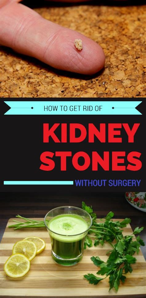 How to Get Rid of Kidney Stones: 10,000+ Ways