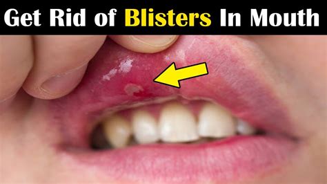 How to Get Rid of Mouth Blisters: A Definitive Guide to 2025