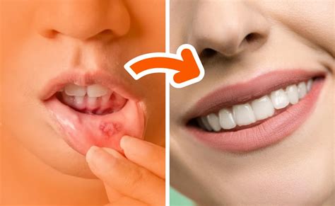 How to Get Rid of Mouth Ulcers Fast in 5 Simple Steps