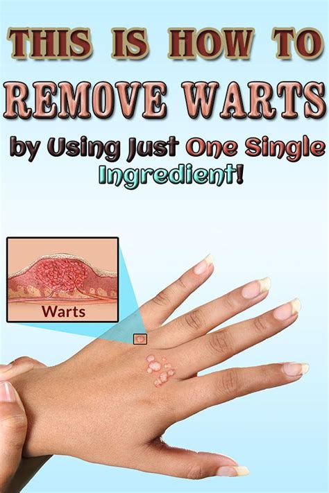 How to Get Rid of Warts: 5 Proven Methods (2025)